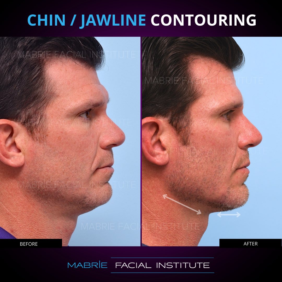 Jawline Filler for Definition & Contour (Updated 2023) – Mabrie Facial  Institute