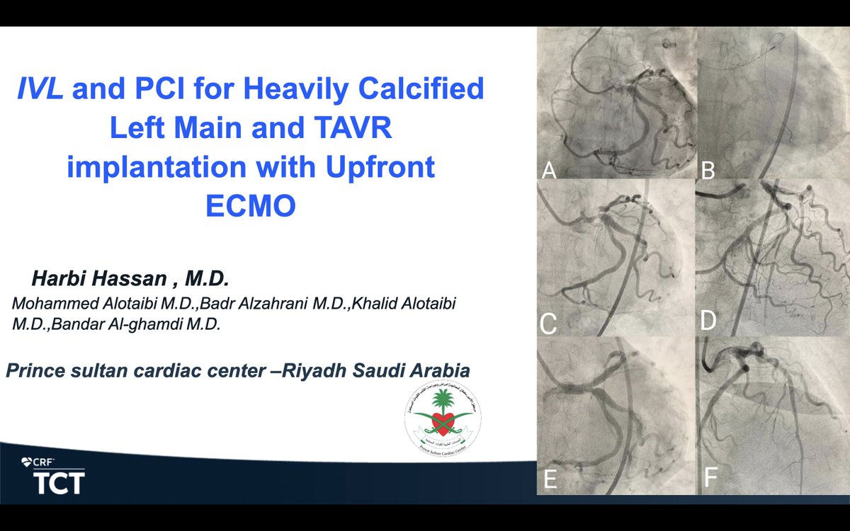 hassan_alharbi's tweet photo. So grateful to have had the opportunity to present my work with colleagues at @TCTConference #TCT2021 on IVL and PCI LM with TAVR implantation ,upfront ECMO https://t.co/U1C9jXnnh2