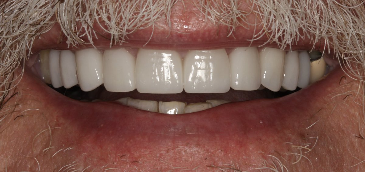 AmarilloSmiles's tweet photo. Artistic cosmetic smile rejuvenation utilizing porcelain veneers. #cosmeticdentist #smilemakeover https://t.co/T7JRfPOC1X