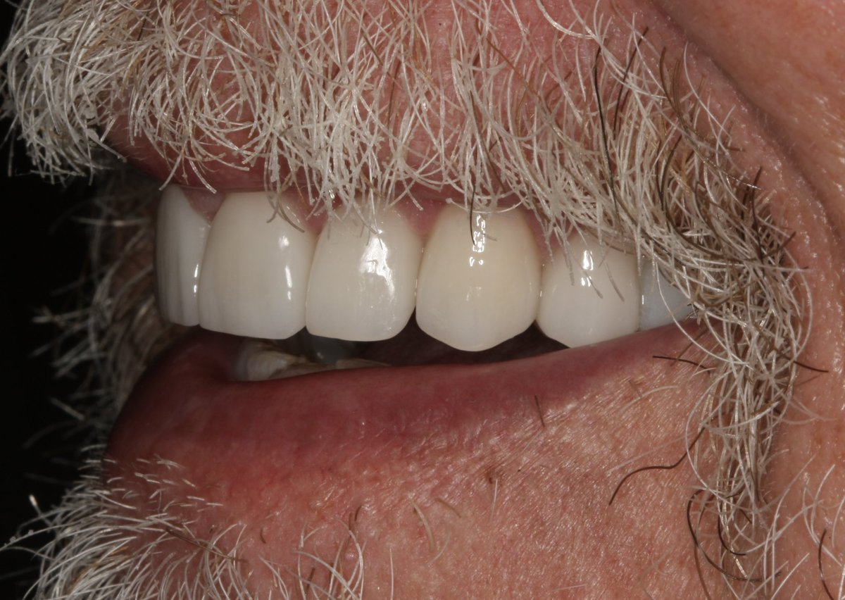 AmarilloSmiles's tweet photo. Artistic cosmetic smile rejuvenation utilizing porcelain veneers. #cosmeticdentist #smilemakeover https://t.co/T7JRfPOC1X