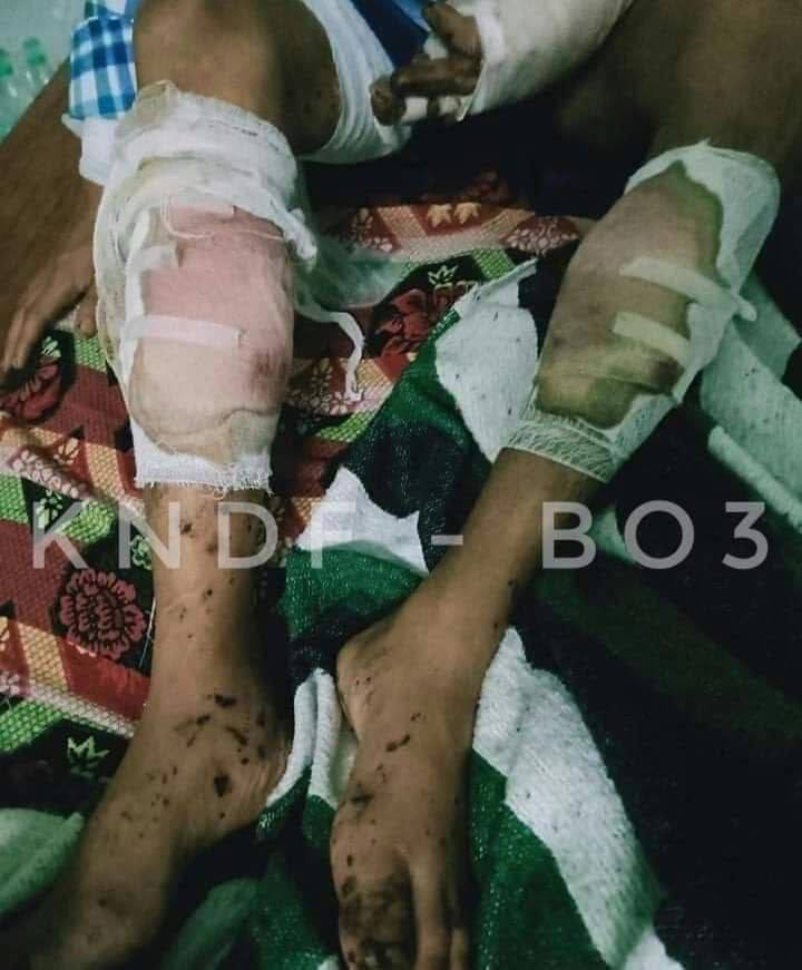 EnicsKyaw's tweet photo. Tw // Sensitive Content
APhekone PDF Comrade,an art enthusiast who was able to create the most beautiful sounds with his soft and beautiful fingers,accidentally injured while working on a mission.
#Nov5Coup 
#WhatsHappeningInMyanmar https://t.co/d2c3vDgeP0 https://t.co/PAdA9OlSA1