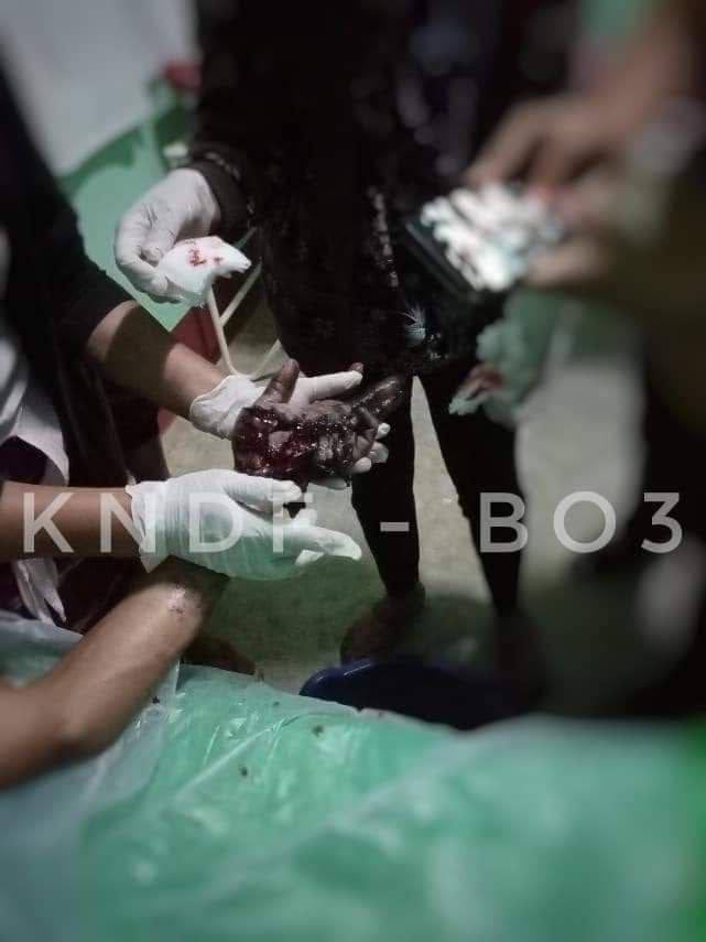 EnicsKyaw's tweet photo. Tw // Sensitive Content
APhekone PDF Comrade,an art enthusiast who was able to create the most beautiful sounds with his soft and beautiful fingers,accidentally injured while working on a mission.
#Nov5Coup 
#WhatsHappeningInMyanmar https://t.co/d2c3vDgeP0 https://t.co/PAdA9OlSA1