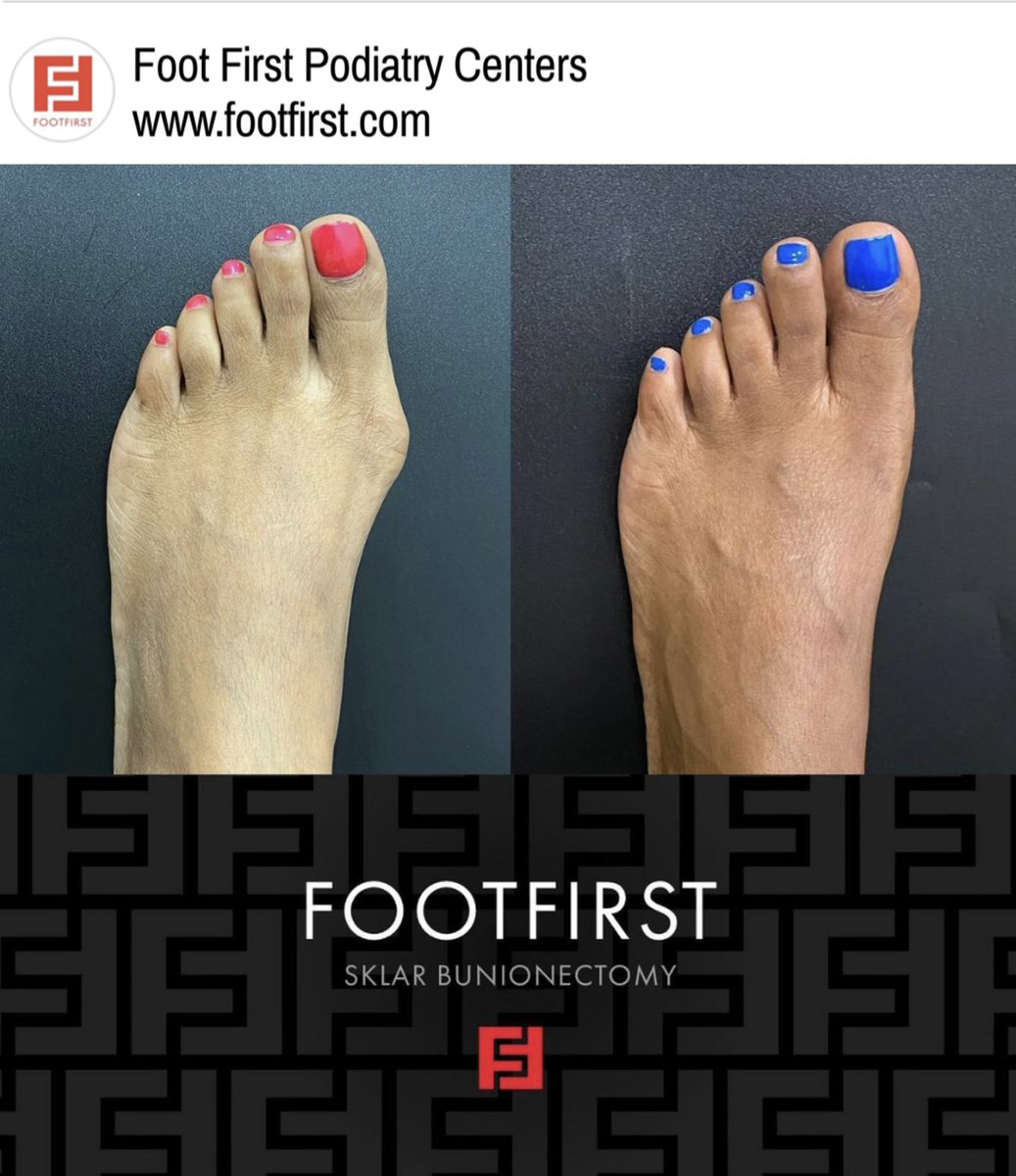 footfirstpod's tweet photo. Getting rid of a little bump makes a huge difference when it comes to the way your foot looks and feels ☺️. No matter big or small all #bunions can cause pain 😖. Count on the Sklar Bunionectomy®️to Fix Your Feet Beautifully™️ without a cast, crutches or visible scar. https://t.co/cba8xErOn3