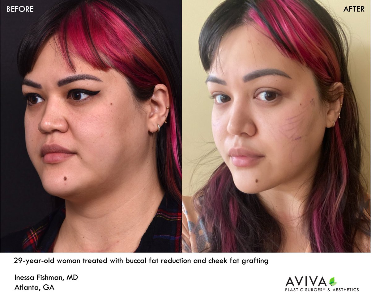 AvivaPSA's tweet photo. #Buccalfat reduction treats overly full lower cheeks for patients bothered by a "baby face" or "chipmunk cheeks."  This is a minor surgery, often performed in the office with the help of injectable numbing medicine.  Check out our patient's #beforeandafter 1 day after treatment! https://t.co/GDC1VMtGJd