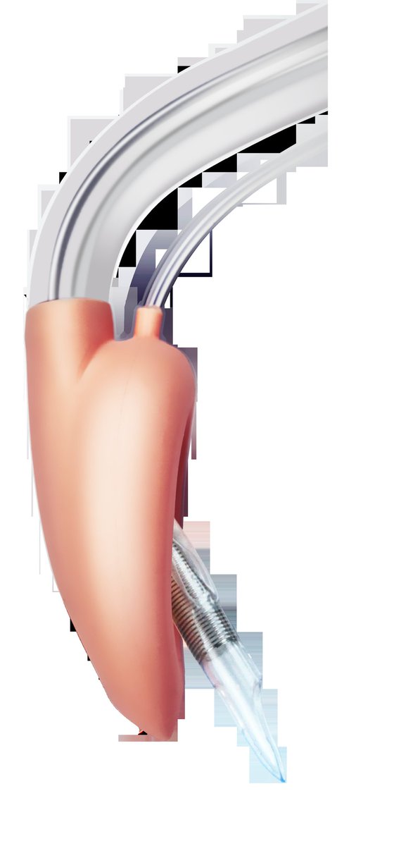 TuorenMedical's tweet photo. More than 95 degree angulated short airway tube matches oropharyngeal curve, easy for insertion. Besides, equipped with the dedicated endotracheal tube and exchange guide. Come and take a look at our Blockbuster laryngeal Mask which with high hemodynamic stability. #Airway https://t.co/UOPNFNFRYz