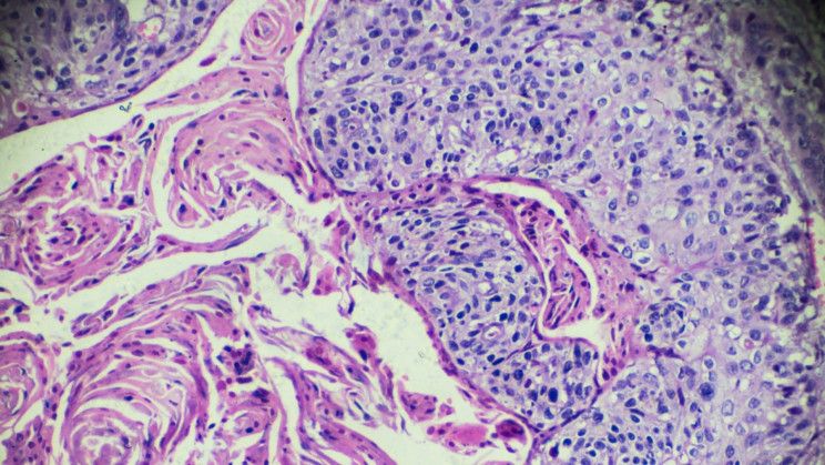 It's Official. The HPV Vaccine Reduced Cervical Cancer Cases by Almost 90% buff.ly/3F5wPUn