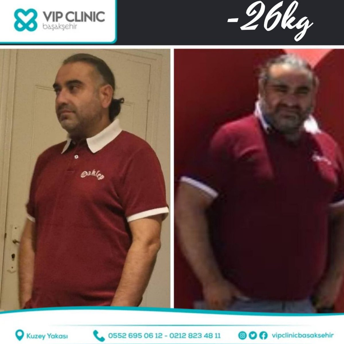 fatihciftcitr's tweet photo. İlhan bey uyku-apne sendromu ve fazla kilolarından dolayı aşırı derecede muzdaripti. İki ay önce başarılı bir tüp mide ameliyatı oldu. Şu an sıkıntıları ortadan kalkmaya başlayan İlhan bey mutlu biz mutlu.#vipclinicbasaksehir #başakşehir
#midefıtığı #reflu #gastricbpass #tüpmide https://t.co/08uhuFseQM