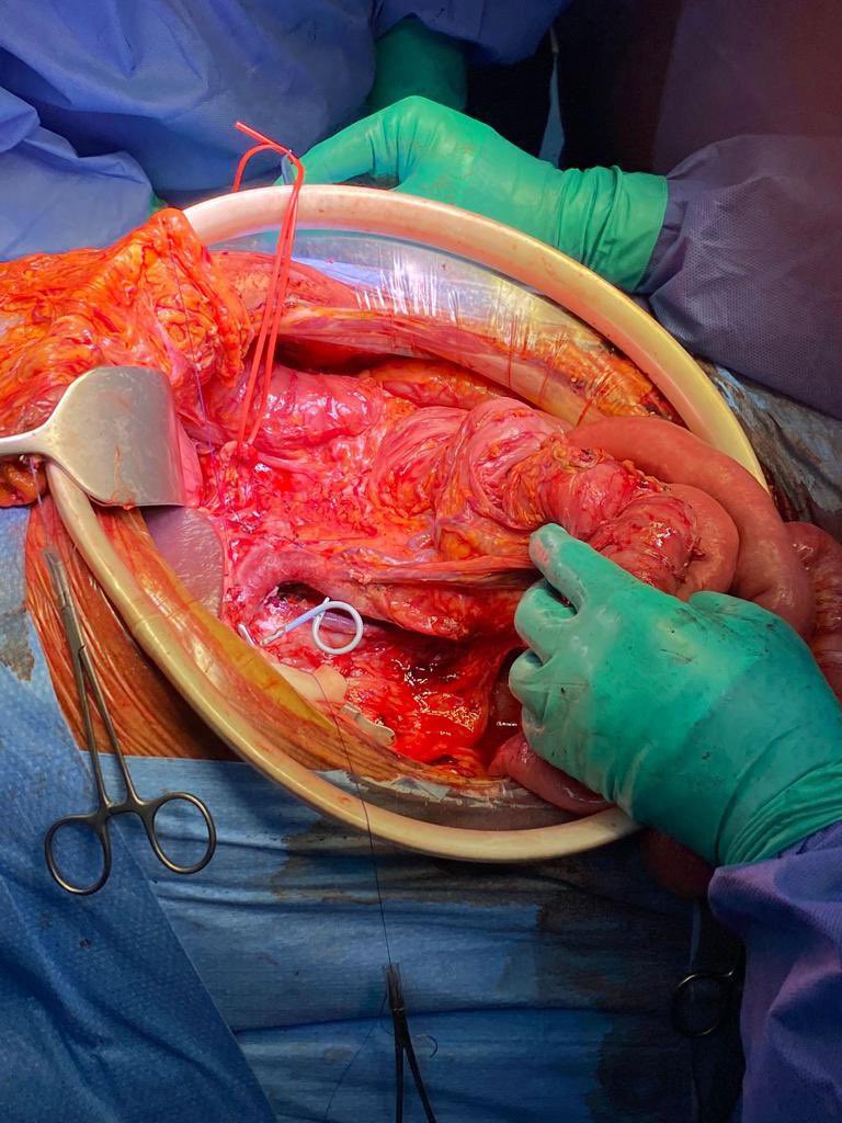 PP Whipple procedure combined with spleen preserving total pancreatectomy and Inter-aorto-caval lymphoadenectomy 3 #pancreaticsurgery