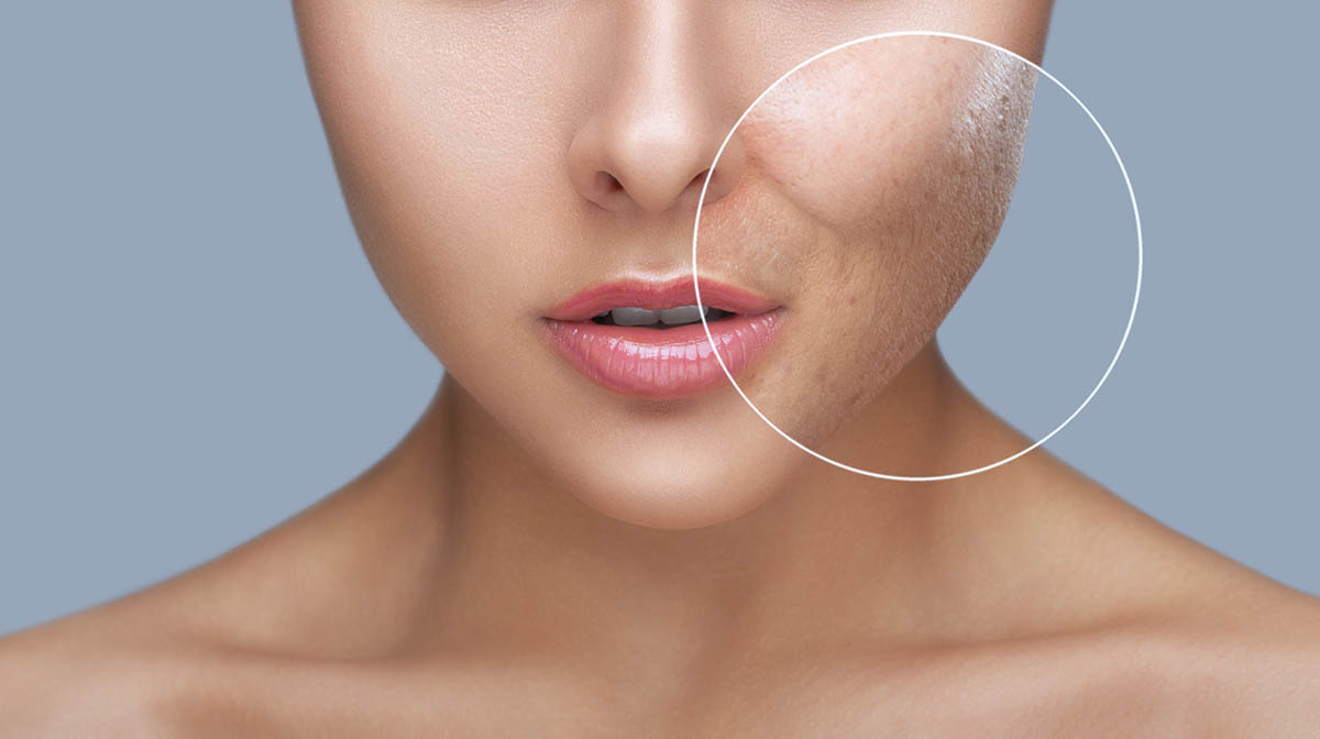 SkinBodyRenewal's tweet photo. If you already have acne scarring, it’s never too late to act. The fresher the scar, the better your results, but you can improve the appearance even of old scars https://t.co/awOS21VeBj
#SkinRenewalsa #BeyondBeauty #skin #acne #Breakouts #scars #laser #subcision #carboxytherapy https://t.co/TmUQmxQUNV