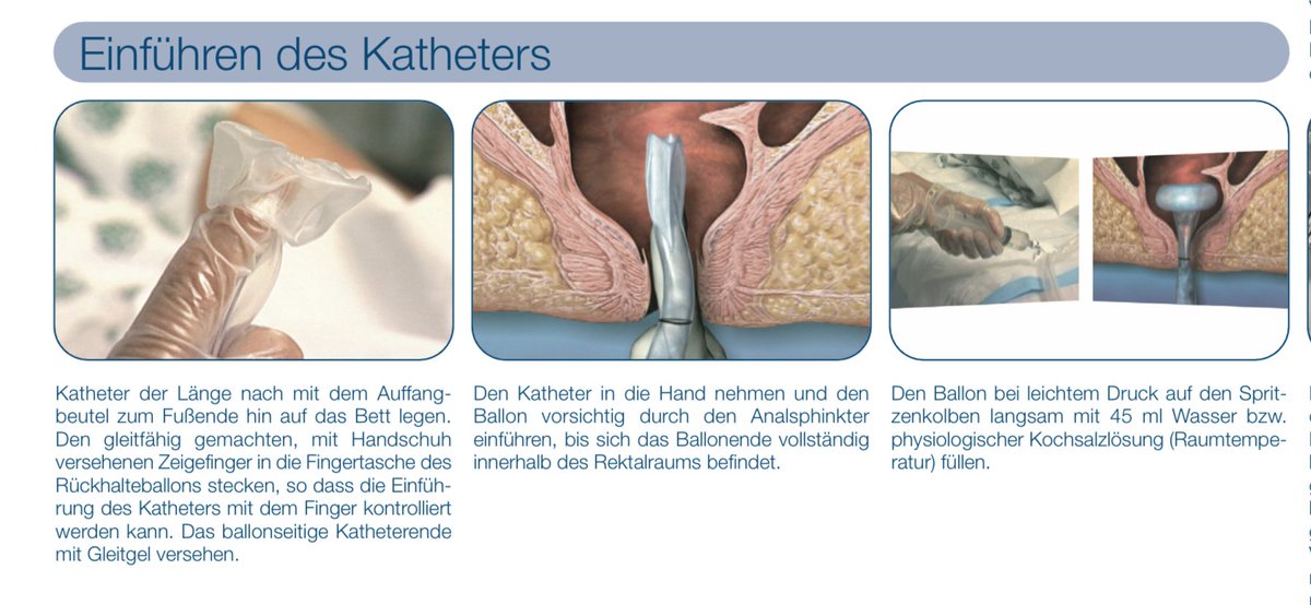 Hab mich mit <a href="/SchoenMuc/">Johannes Schön 🪐🔭</a> über Intensivmedizin unterhalten und er meinte, wen ein Tubus schon nicht beeindruckt der sollte wissen, dass wir beatmete Patienten oft mit einem dauerhaften Stuhldrainagesystem versorgen und dazu einen geblockten Plastikballon in den Anus einlegen.