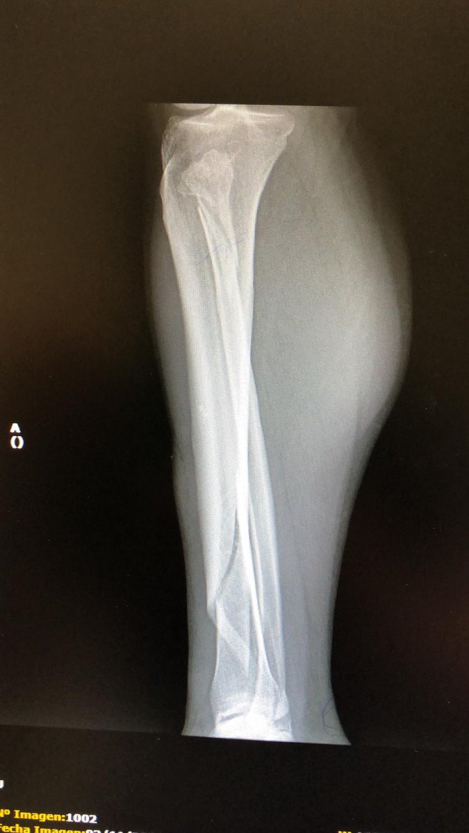 sorry I've been offline. 

this thread is not for the squeamish.

squeam is obligatory.

you don't need to be a radiologist to know you need both fibula and tibula to stop your foot waggling like an eel and your leg bending from the knee like a flaccid sausage.
