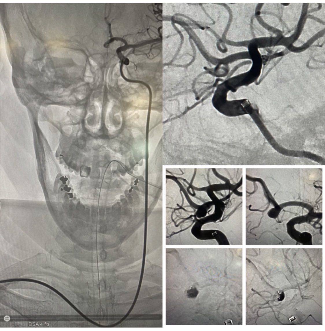 JanKarlBurkhar1's tweet photo. That’s a wrap. Back to back #radial interventions with radial access systems: #WEB17 @MV_Terumo with #Armadillo @q_apel sheathless bareback using Armadillo dilator and Pipeline🛡#flowdiverter with #Rist @Medtronic #radial #aneurysm @PennNSG @PennMDForum https://t.co/aRiGJUYrdH