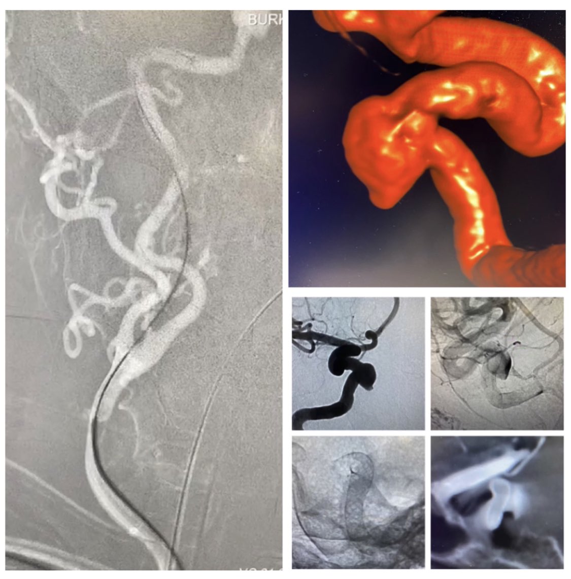 JanKarlBurkhar1's tweet photo. That’s a wrap. Back to back #radial interventions with radial access systems: #WEB17 @MV_Terumo with #Armadillo @q_apel sheathless bareback using Armadillo dilator and Pipeline🛡#flowdiverter with #Rist @Medtronic #radial #aneurysm @PennNSG @PennMDForum https://t.co/aRiGJUYrdH
