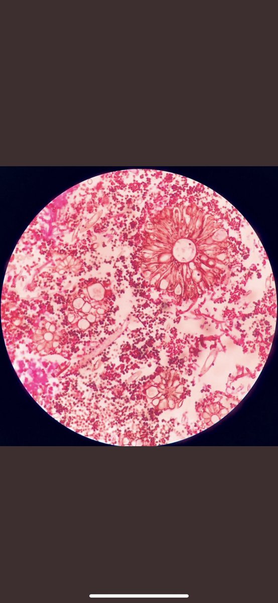 MehtaSameera's tweet image. Aspergillus Fruiting Body seen in nasal crusts. #LoveForPath #Fungus #Histopathology #LongCovid #Covid #Twitterhomework @loyolapathology @KMirza