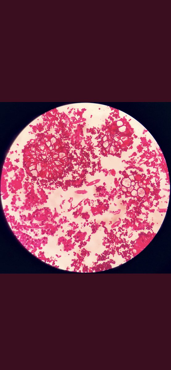 MehtaSameera's tweet image. Aspergillus Fruiting Body seen in nasal crusts. #LoveForPath #Fungus #Histopathology #LongCovid #Covid #Twitterhomework @loyolapathology @KMirza