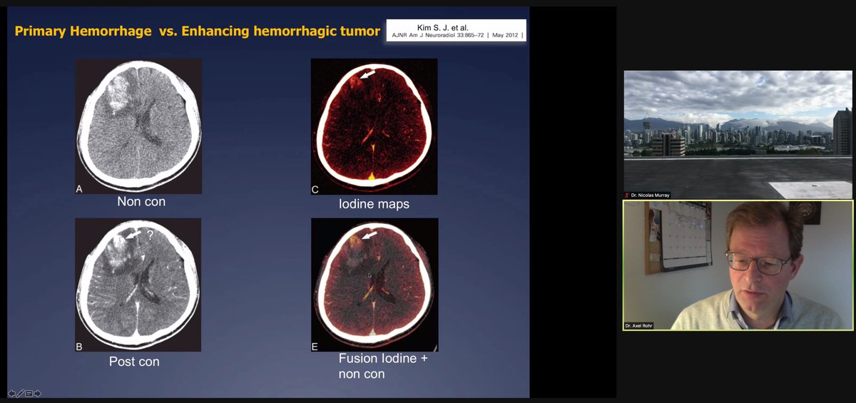 Emil_LeeMD's tweet photo. Dr. Alex Rohr of @UBC_Radiology discusses #DualEnergyCT uses in #Neuroradiology applications

@BCRadSoc Webinar: "Introducing Dual Energy CT to Your Practice" https://t.co/o8iFBtoUrI