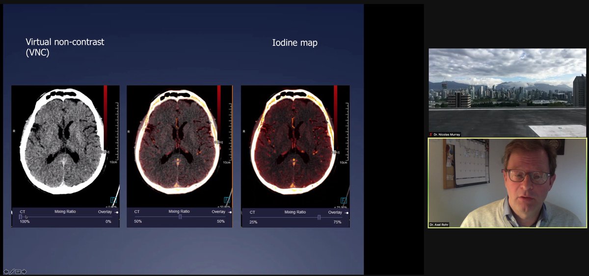 Emil_LeeMD's tweet photo. Dr. Alex Rohr of @UBC_Radiology discusses #DualEnergyCT uses in #Neuroradiology applications

@BCRadSoc Webinar: "Introducing Dual Energy CT to Your Practice" https://t.co/o8iFBtoUrI