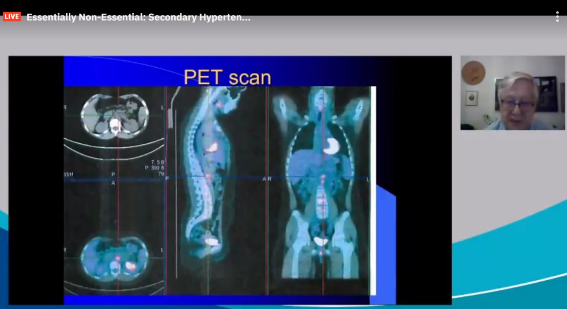 drM_sudha's tweet photo. Takayasu:
widespread disease
sicker
>50% both renal arteries, marked intrarenal disease
25%: mid-aortic syndromes
PET scan helpful
#ASNKids21 #KidneyWk #HTN #PedsHTN #renovascularHTN #SecondaryHTN
@ASPNeph @AspnResearch @ASNKidney https://t.co/7HigJj4wB9