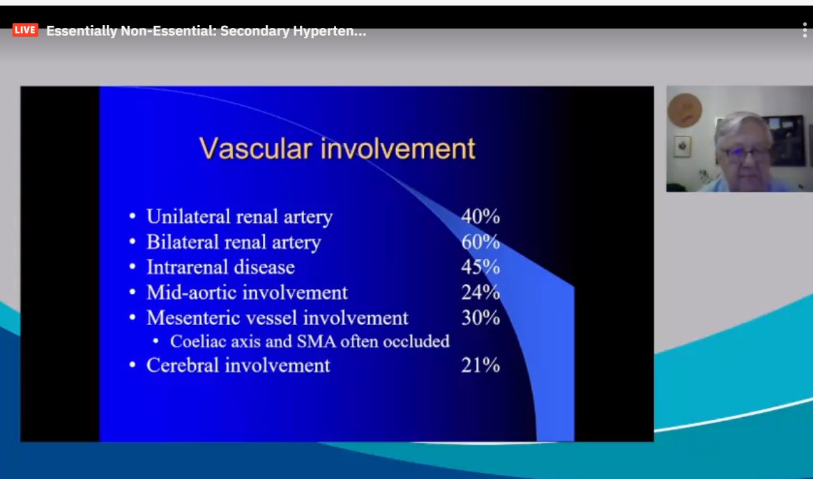 drM_sudha's tweet photo. Takayasu:
widespread disease
sicker
>50% both renal arteries, marked intrarenal disease
25%: mid-aortic syndromes
PET scan helpful
#ASNKids21 #KidneyWk #HTN #PedsHTN #renovascularHTN #SecondaryHTN
@ASPNeph @AspnResearch @ASNKidney https://t.co/7HigJj4wB9