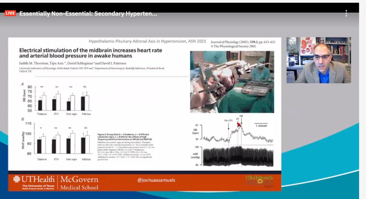 drM_sudha's tweet photo. sympathectomy controlled severe HTN - oldest
stimulation of hypothalamus--> BP spike in 1 sec in cats (oldest)
similar studies ~ 20 yrs ago in humans
effects abolished if pituitary & adrenal removed.
#ASNKids21 #KidneyWk #HTN #secondaryHTN #PedsHTN #HPAaxis
@ASPNeph @AspnResearch https://t.co/Wyn2ejjHYt