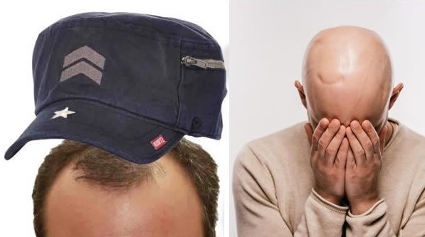 Alopecia en hombres: sombreros para usar y sentirte más seguro