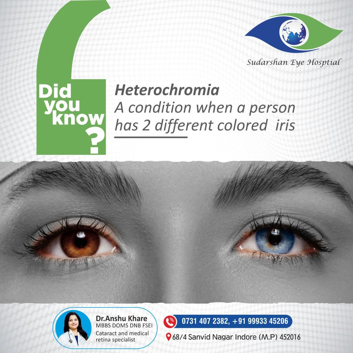 Heterochromia is when a person has differently colored eyes or eyes that have more than one color.

#sudarshaneyecareindore #glaucoma #retina