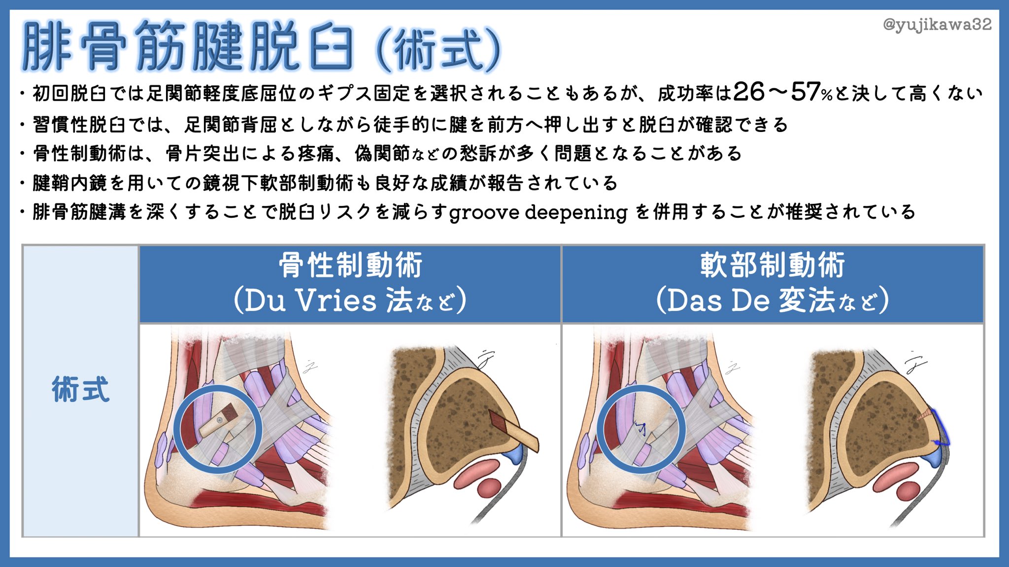 ユジカワ 整形dr イラストレーター 再投稿 何度か再投稿している気もしますが 自信作かつお気に入りの一つ エコー下に生食注射した上で 背屈外がえしをすると脱臼を再現しやすい 骨折が無いから湿布で様子見という事例がいまだにあることは残念