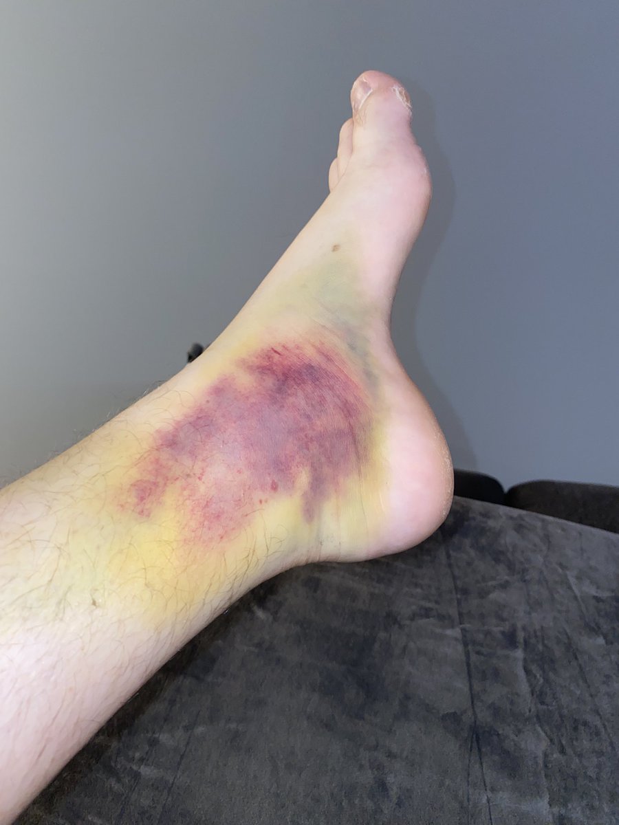 ForkBuns's tweet photo. What the hell. #brokenankle https://t.co/eCgCTWaGVq