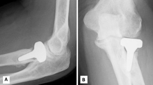 Clinorthop's tweet photo. ICYMI: Despite high rates of reoperation, patient reported outcome remains positive following acute radial head replacement #elbow #QuickDASH @DuckworthOrthEd @EdinburghTrauma @RIE_Lothian
https://t.co/r34keCVDhm https://t.co/RPSKe2UpvD