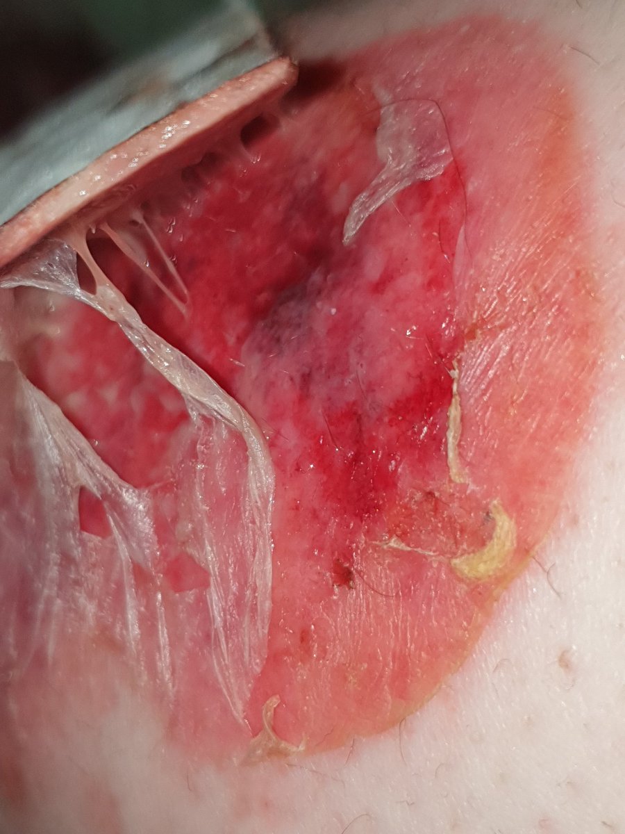 1bullet__'s tweet photo. throwback to when i had a trial day at a dog kennel and they scratched the fuck outta my leg burn 💔 https://t.co/2bBf9M4t9U