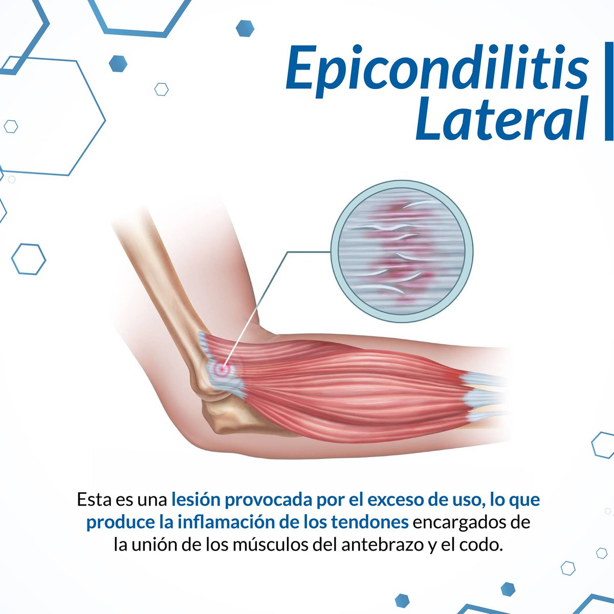 lopezcorcuera's tweet photo. La Epicondilitis Lateral es conocida popularmente como codo de tenista. Esta es una lesión provocada por el exceso de uso que produce la inflamación de los tendones del codo. Es muy común en trabajos con movimientos muy repetitivos. https://t.co/CDpksZclNA