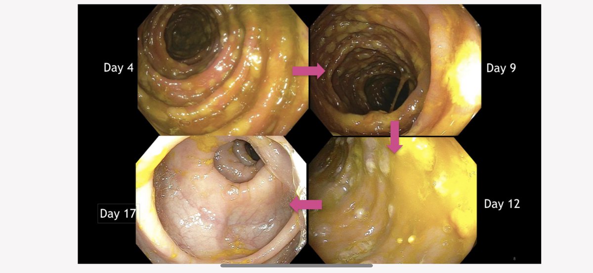 Bhavana Bhagya Rao (@bhavanabraomd) on Twitter photo A wonderful teaching case of severe complicated C diff diarrhea 💩with toxic mega colon, treated with #FMT <a href="/MountSinaiGI/">Mount Sinai Division of Gastroenterology</a> @icahnmountsinai•The 💪 of💩• For more details check out Case 10 @GiSim_website at gi-sim.com
@ShabariShenoy <a href="/J_YoonYoon/">Ji Yoon Yoon</a> <a href="/grinsa01/">Ari Grinspan</a> A wonderful teaching case of severe complicated C diff diarrhea 💩with toxic mega colon, treated with #FMT <a href="/MountSinaiGI/">Mount Sinai Division of Gastroenterology</a> @icahnmountsinai•The 💪 of💩• For more details check out Case 10 @GiSim_website at gi-sim.com
@ShabariShenoy <a href="/J_YoonYoon/">Ji Yoon Yoon</a> <a href="/grinsa01/">Ari Grinspan</a>
