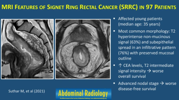 Abdominal_Rad's tweet photo. Graphic Abstract published 8/24/2021 #abdradj

MRI features of signet ring rectal cancer

Suthar et al

https://t.co/xiATBilljF https://t.co/Rc8x7oLoJP