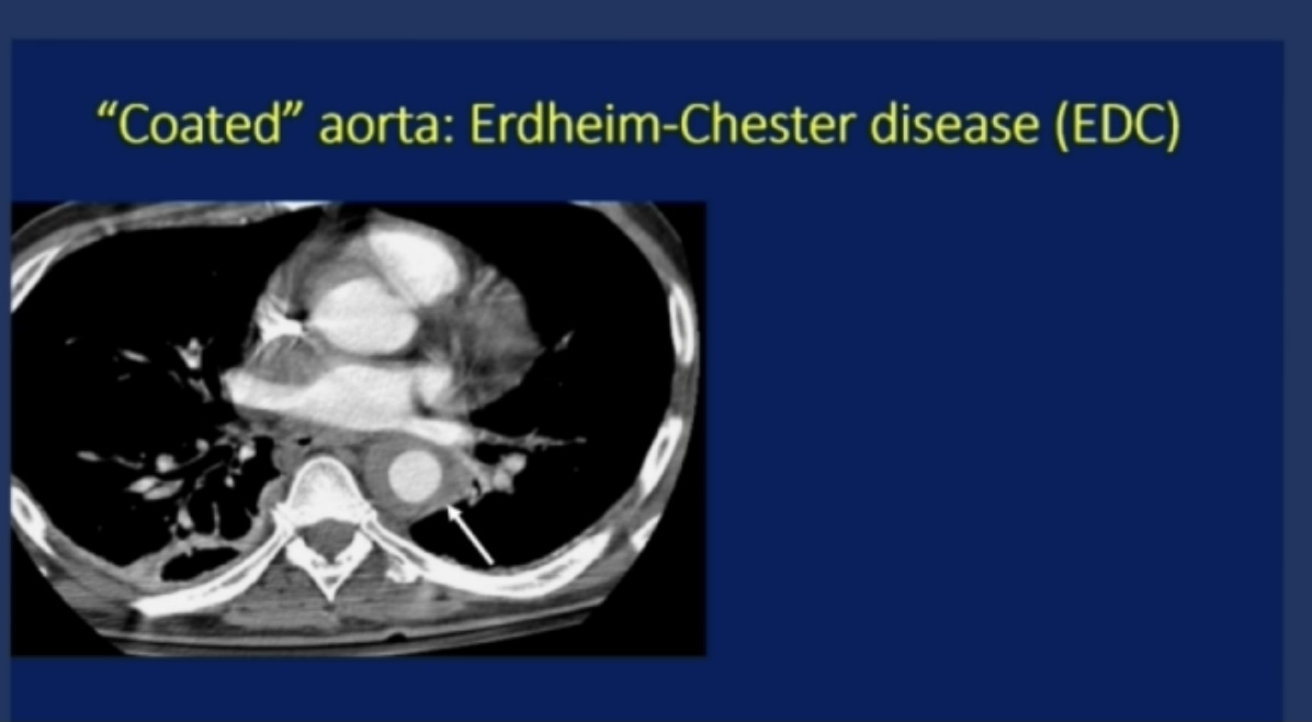 Clinical Pearl at #ACR21 from Dr. J. Stone: 

⭐️Tissue biopsy is not essential in diagnosing IgG4-related dz in a pt w/ a typical pattern of retroperitoneal fibrosis.

⭐️Periaortitis ('coated' aorta) w/ 'hairy' kidney is NOT IgG4 but rather Erdheim-Chester Dz

#ACRBest @Rheumnow