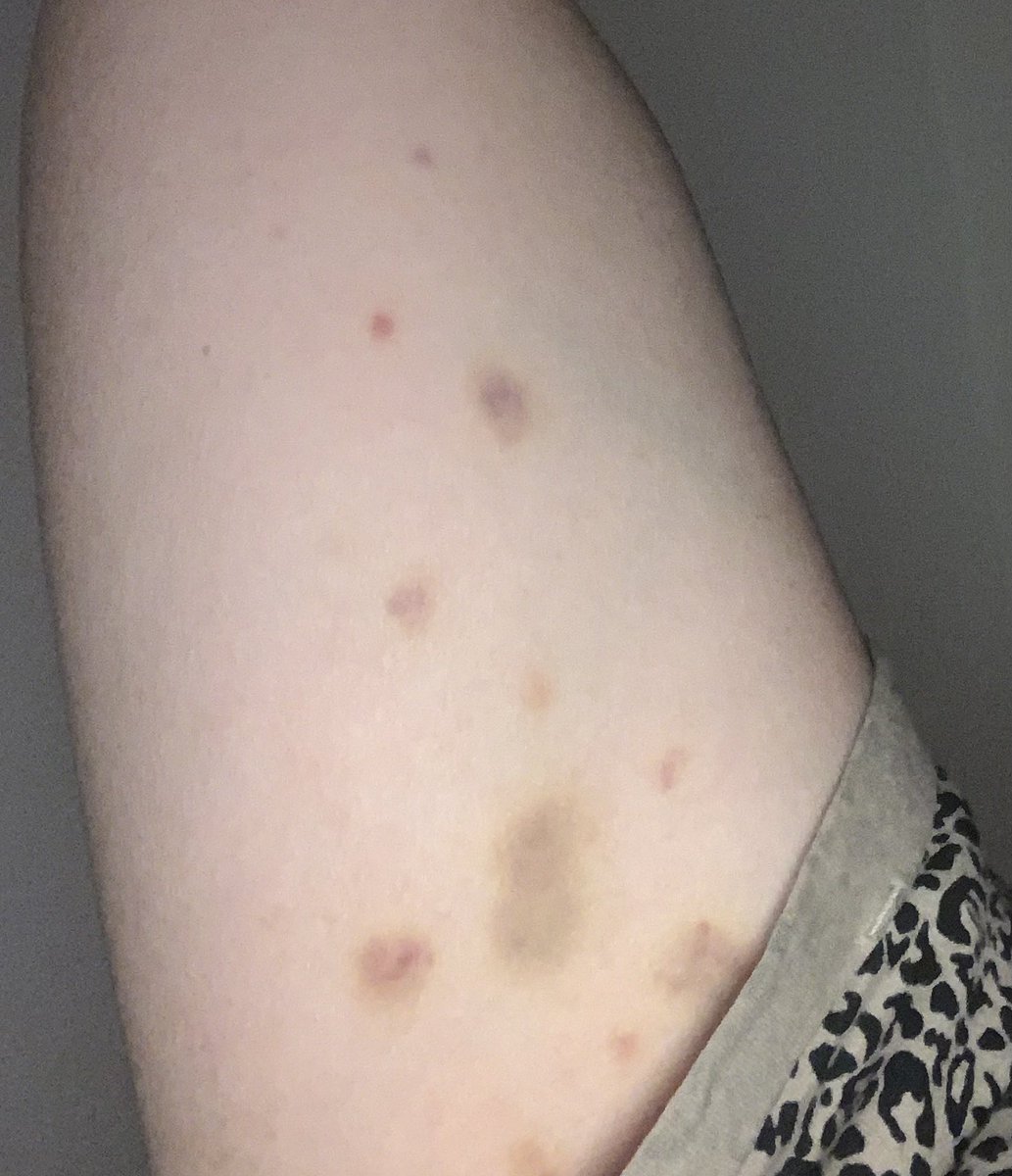 neete5's tweet photo. Anyone know what has caused these bruises , and are they cause for concern https://t.co/sByKdajKZg