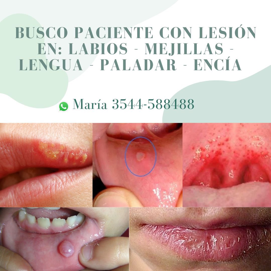 mariadlacolina's tweet photo. ODONTOLOGÍA GRATIS ‼️
Busco pacientes con alguna lesión en boca (ampollas, manchas, aftas, bultos, etc)  🦷🙌🏼 @VivireNuevaCba https://t.co/XQQ9oOH6kw