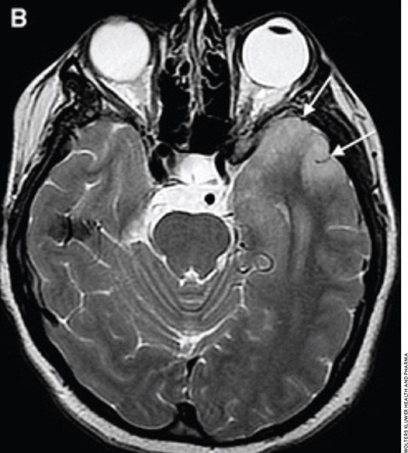 A recent study published in <a href="/JAMANeuro/">JAMA Neurology</a> found that early treatment results in the best outcomes for NMDA receptor encephalitis. bit.ly/3CRiQ3s
#NMDARE #NeuroTwitter