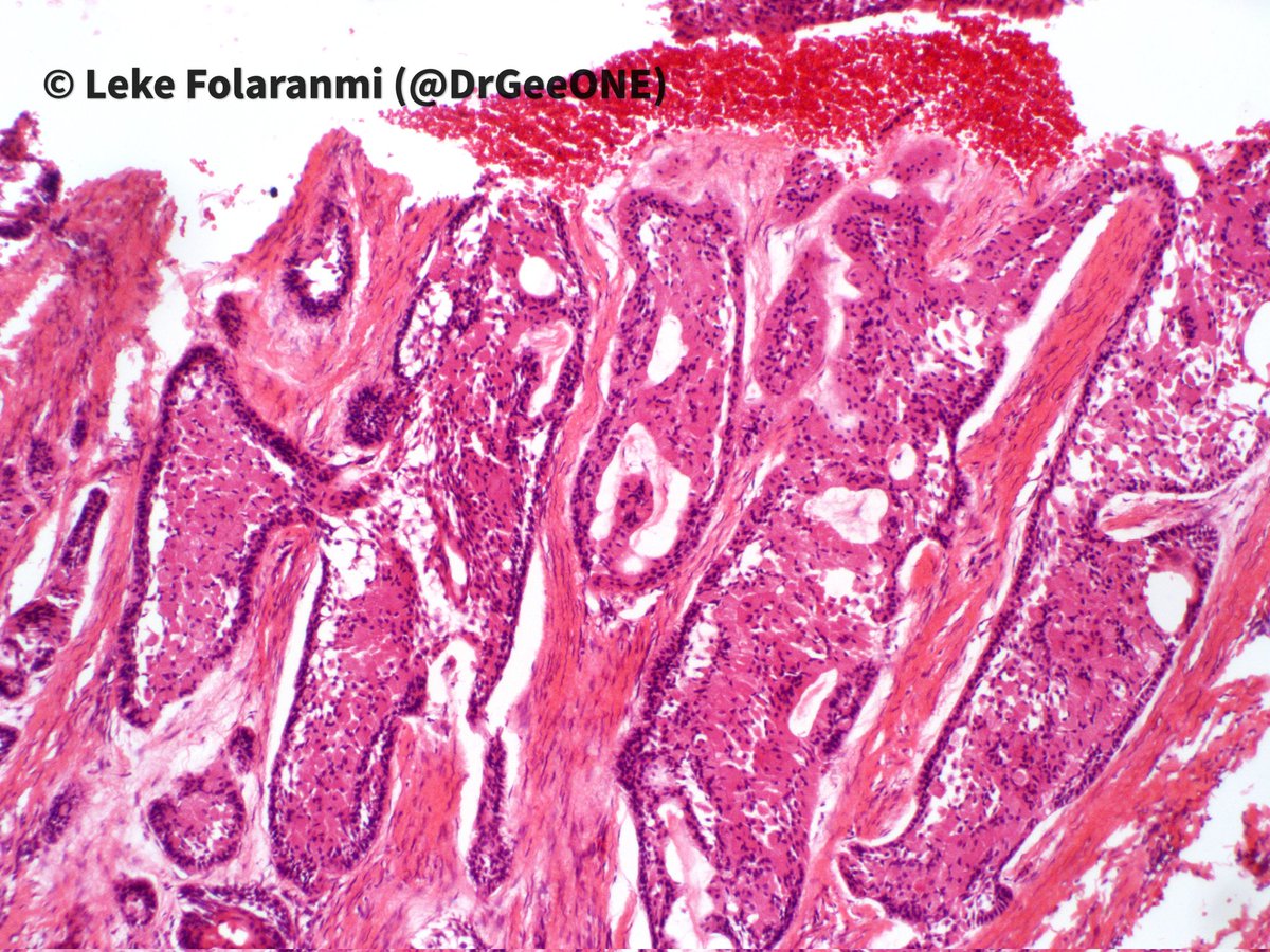 DrGeeONE's tweet photo. Jaw mass in a male (middle aged-elderly)
🔅Granular cell Ameloblastoma
-Rare subtype seen in 1.5-5% of all Ameloblastomas. 
-Granular appearance due to prominent lysosomes.
I think I first saw this entity here on #PathTwitter years ago. 
Sharing for the beauty! #OralPath #HNPath https://t.co/rROG3MAIeG