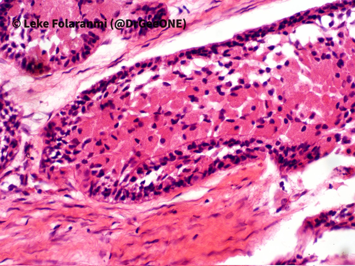 DrGeeONE's tweet photo. Jaw mass in a male (middle aged-elderly)
🔅Granular cell Ameloblastoma
-Rare subtype seen in 1.5-5% of all Ameloblastomas. 
-Granular appearance due to prominent lysosomes.
I think I first saw this entity here on #PathTwitter years ago. 
Sharing for the beauty! #OralPath #HNPath https://t.co/rROG3MAIeG