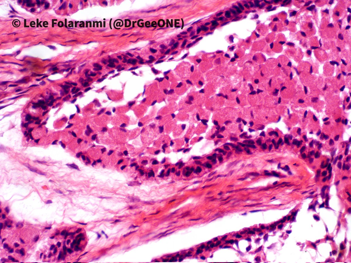 DrGeeONE's tweet photo. Jaw mass in a male (middle aged-elderly)
🔅Granular cell Ameloblastoma
-Rare subtype seen in 1.5-5% of all Ameloblastomas. 
-Granular appearance due to prominent lysosomes.
I think I first saw this entity here on #PathTwitter years ago. 
Sharing for the beauty! #OralPath #HNPath https://t.co/rROG3MAIeG