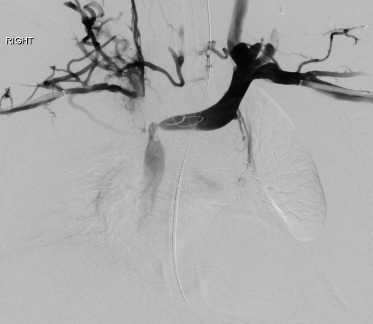 MinaMakaryMD's tweet photo. History of cvc-related right central occlusion and left narrowing presenting with debilitating right arm predominant swelling. Underwent recan with kissing stents. Thankfully sx's resolved and remains asymptomatic at 12 mo @OSURadiology @OSUWexMed @SIRspecialists @SIRRFS @SIR_ECS https://t.co/1qta9vLoqM