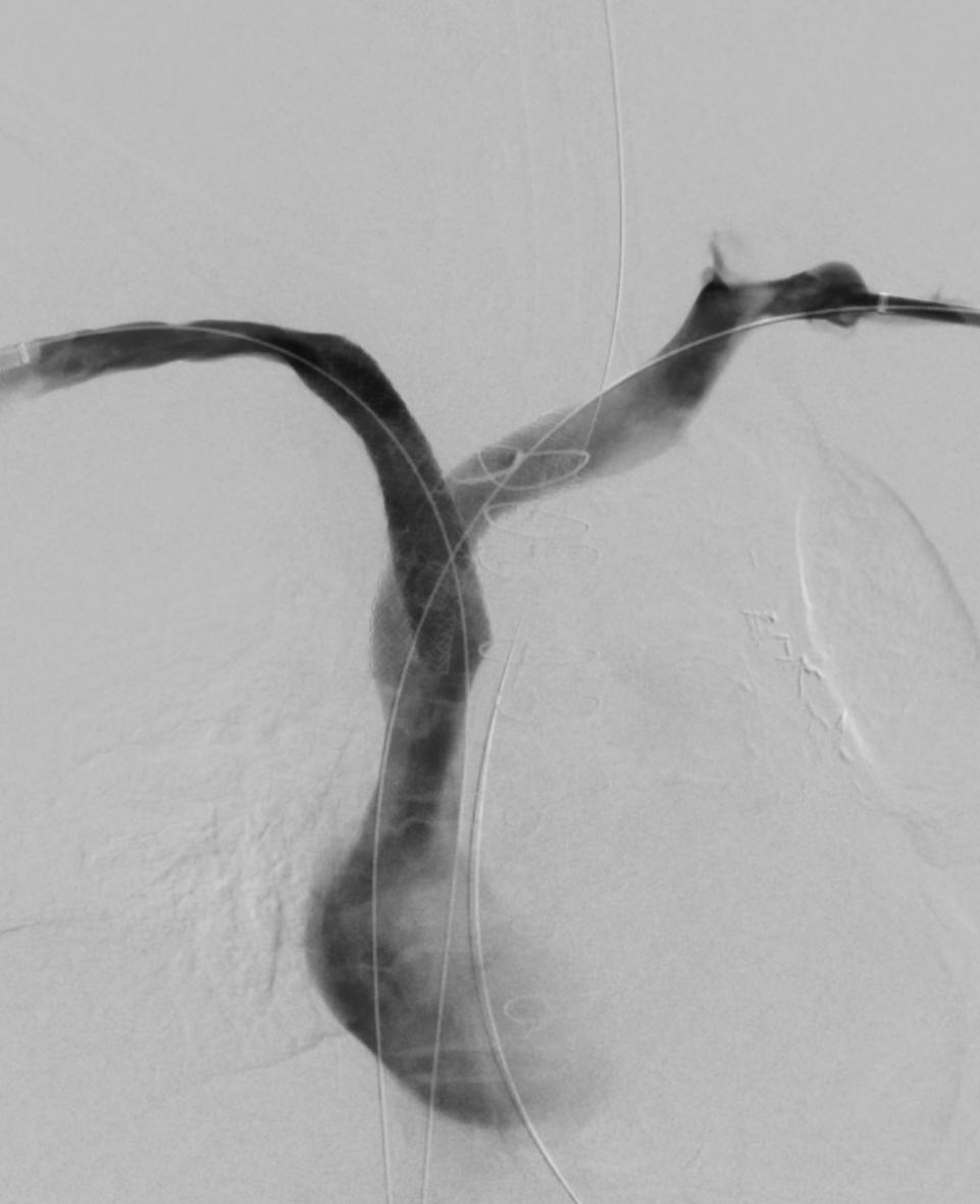 MinaMakaryMD's tweet photo. History of cvc-related right central occlusion and left narrowing presenting with debilitating right arm predominant swelling. Underwent recan with kissing stents. Thankfully sx's resolved and remains asymptomatic at 12 mo @OSURadiology @OSUWexMed @SIRspecialists @SIRRFS @SIR_ECS https://t.co/1qta9vLoqM