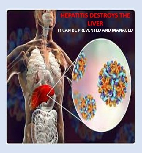 Liver_Advocate's tweet photo. Thread: Hepatitis is the inflammation of the liver. Early diagnosis, vaccination and reduction of exposure is very important in reducing the risk and prevention of the disease. Some of the symptoms of hepatitis is yellow eyes and skin, abdominal pain, nausea and vomiting, https://t.co/fHlgQleTDf
