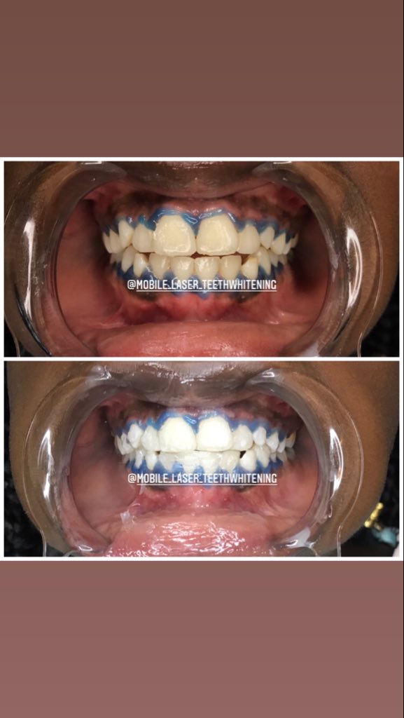 PremierTeeth's tweet photo. Great results from our teeth whitening sessions, #brightsmile #whiten #brighten #teeth #smile  #pearlywhites 
✅50ghs per session https://t.co/fCOw2BgymR