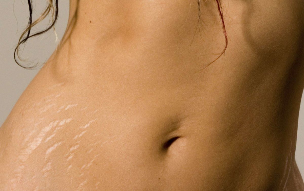 Curiositemujer's tweet photo. ¿Sabes qué es el Láser CO2 fraccionado? es una forma de librarte, por ejemplo, de las estrías purpúricas que tan molestas resultan cuando aparecen a lo largo del cuerpo. Todos sabemos que lo más importante de una persona no es el físico.  #Belleza

https://t.co/f922T1tloV https://t.co/2XRkwF3Yxx