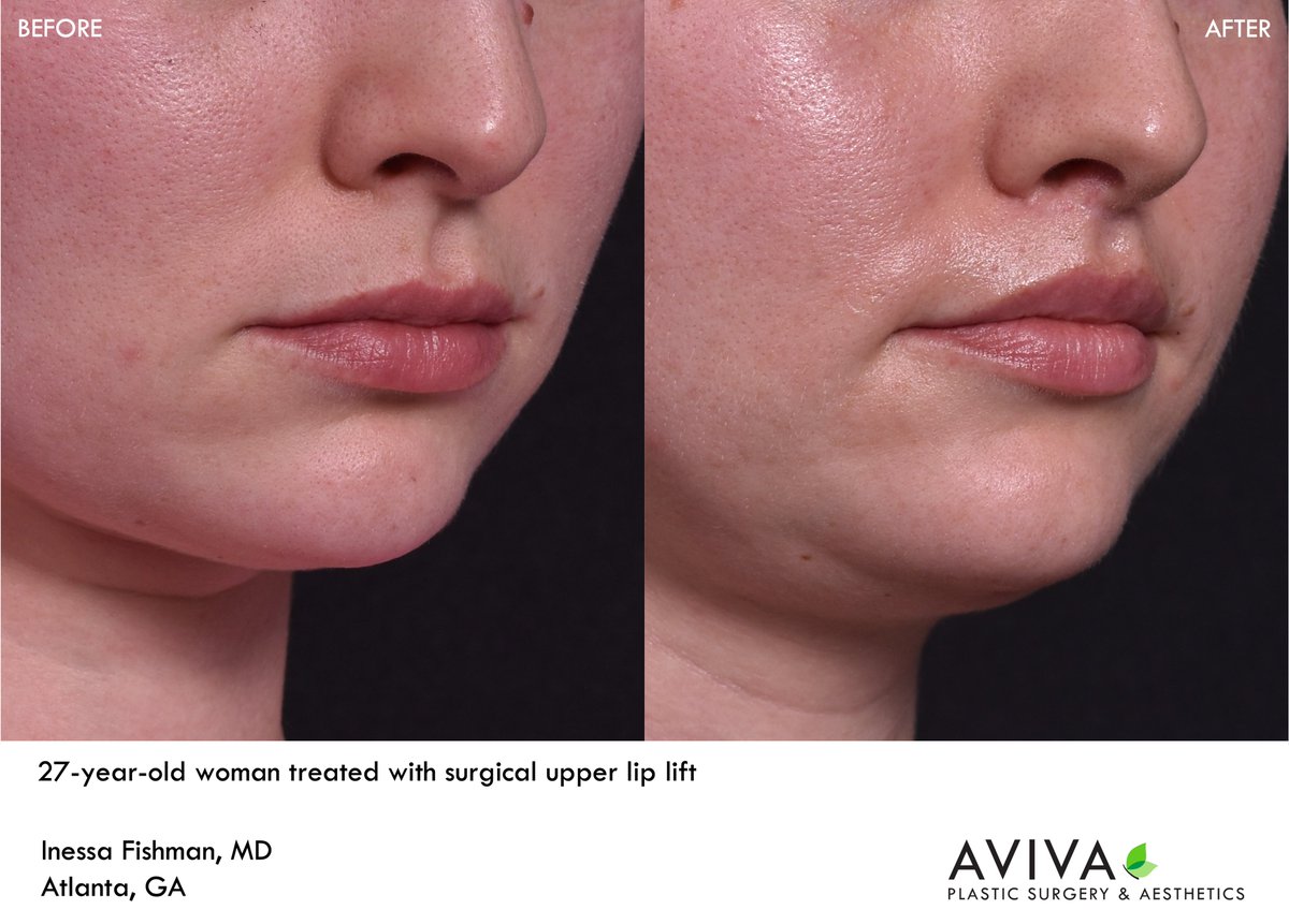 AvivaPSA's tweet photo. A surgical upper lip lift, also known as a #bullhorn #liplift, is a powerful and permanent way to sculpt the upper #lip, making to look more turned out and fuller.  This procedure also shortens the distance between the bottom of the nose and the curvature of the upper lip. https://t.co/7EhOh9Q3Wl