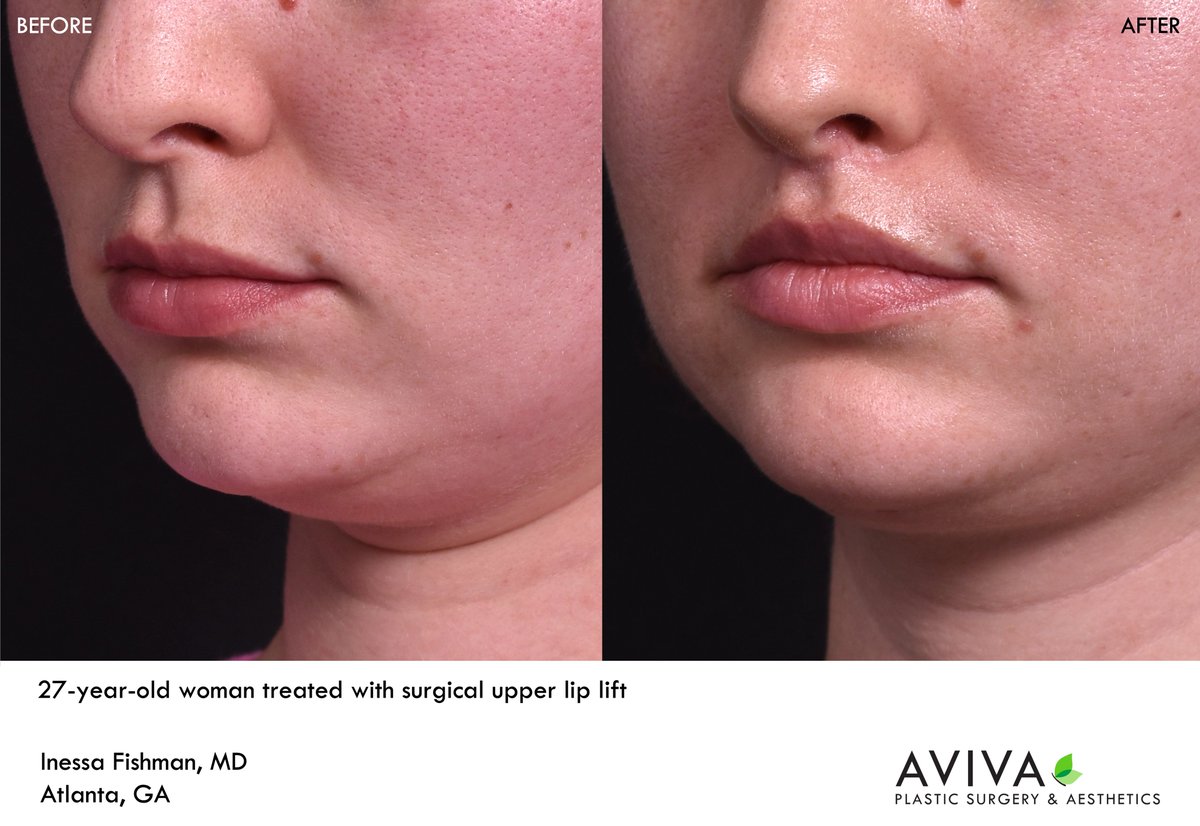 AvivaPSA's tweet photo. A surgical upper lip lift, also known as a #bullhorn #liplift, is a powerful and permanent way to sculpt the upper #lip, making to look more turned out and fuller.  This procedure also shortens the distance between the bottom of the nose and the curvature of the upper lip. https://t.co/7EhOh9Q3Wl