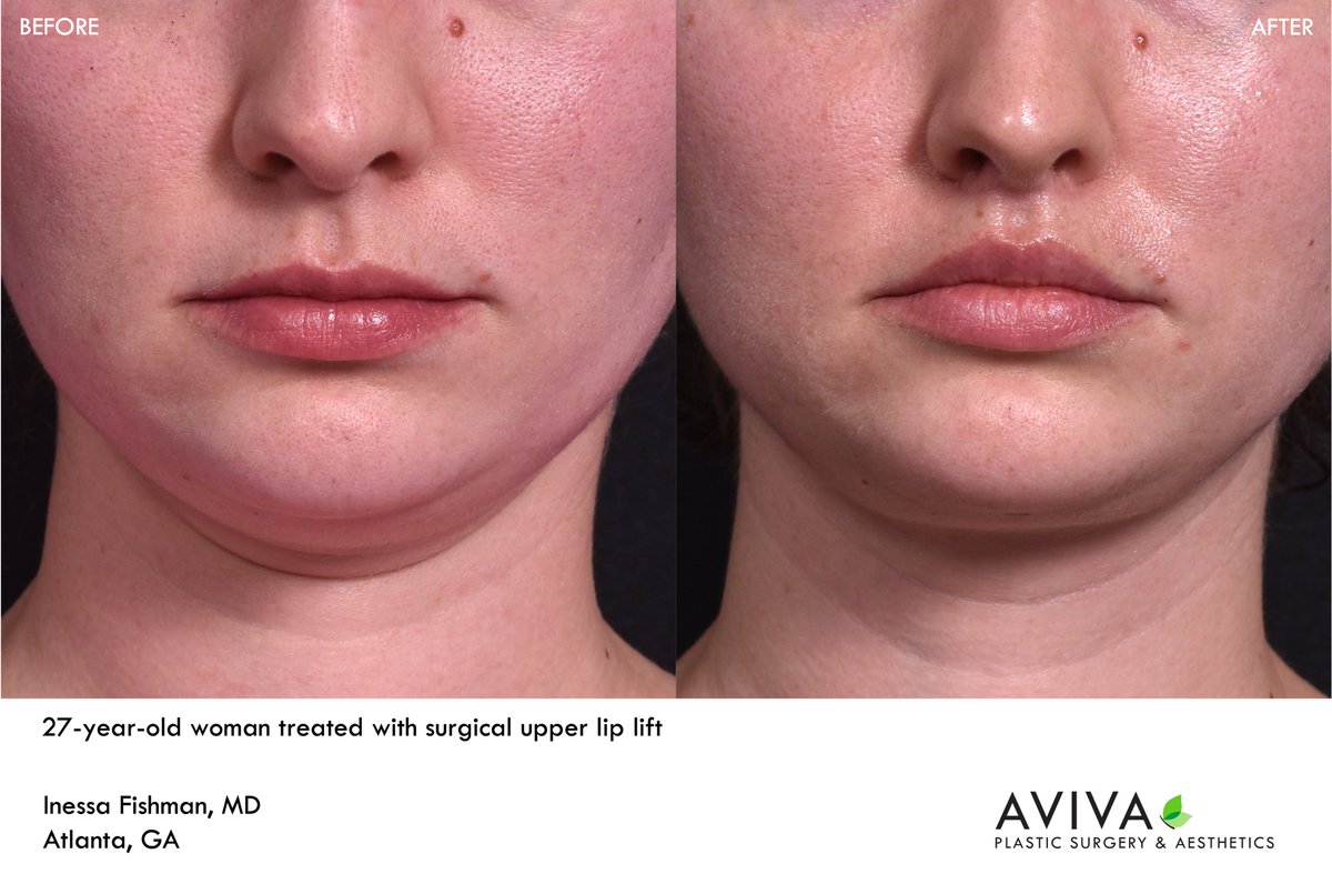 AvivaPSA's tweet photo. A surgical upper lip lift, also known as a #bullhorn #liplift, is a powerful and permanent way to sculpt the upper #lip, making to look more turned out and fuller.  This procedure also shortens the distance between the bottom of the nose and the curvature of the upper lip. https://t.co/7EhOh9Q3Wl