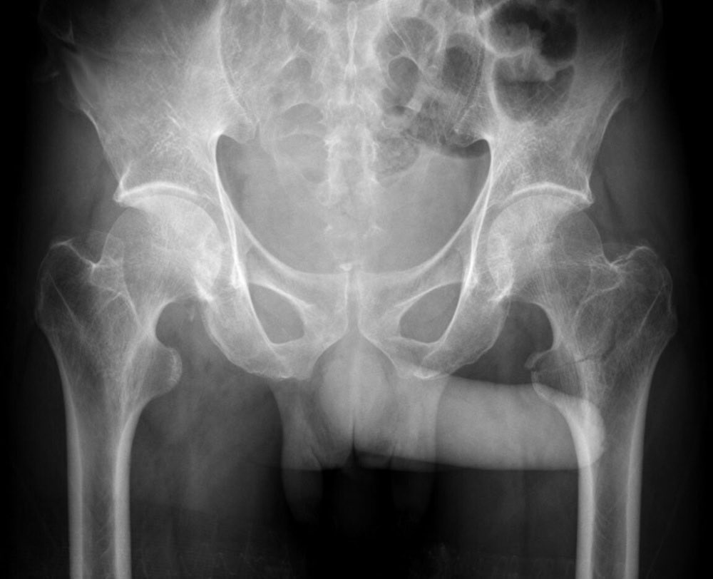 구글에 pelvic x ray 검색하고 이 세상 모든 추들을 보고 옴