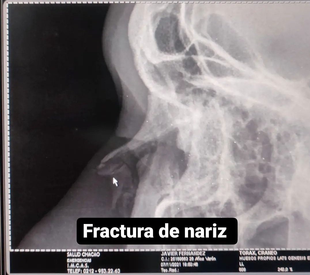 Xavi20230's tweet photo. Javier Fernández, hincha del Deportivo Táchira denunció que fue agredido (dos costillas rotas y fractura de nariz) por hinchas de la barra del Caracas en el clásico disputado en el Olímpico de la UCV. #LigaFUTVE https://t.co/PZWlStRacY